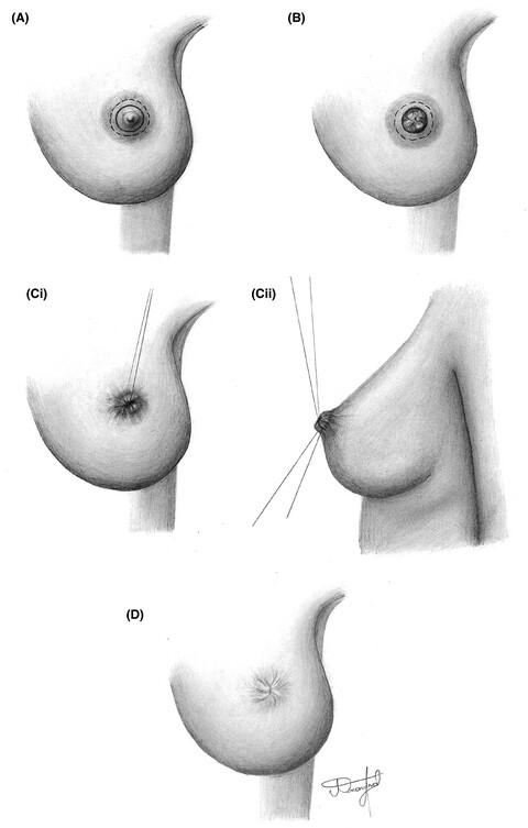 Double purse-string suture surgical wound closure after excision of nipple adenoma of the breast: A case report