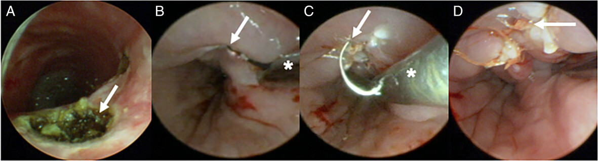Suspension Microesophagoscopy for Endoscopic Suture Closure of Pediatric Tracheoesophageal Fistula