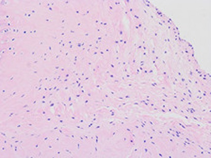 RNAi Silencing of IL-1β and TNF-α in the Treatment of Post-traumatic Arthritis in Rabbits
