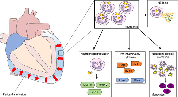 Inflammation and pericarditis: Are neutrophils actors behind the scenes?