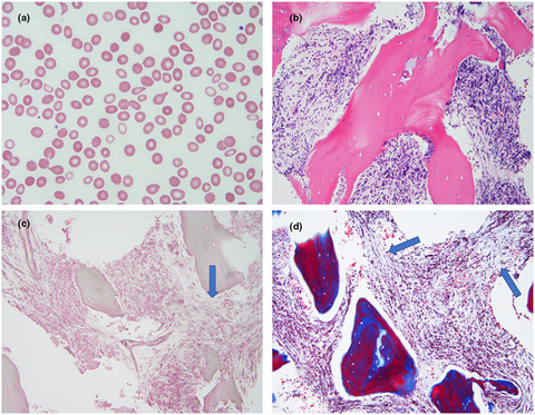 Novel compound heterozygous variants of TBXAS1 presenting with Ghosal hematodiaphyseal dysplasia treated with steroids