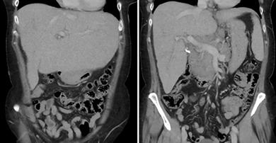 Jaundice, hepatosplenomegaly, and portal lymphadenopathy in a middle-aged female: Is it lymphoma?