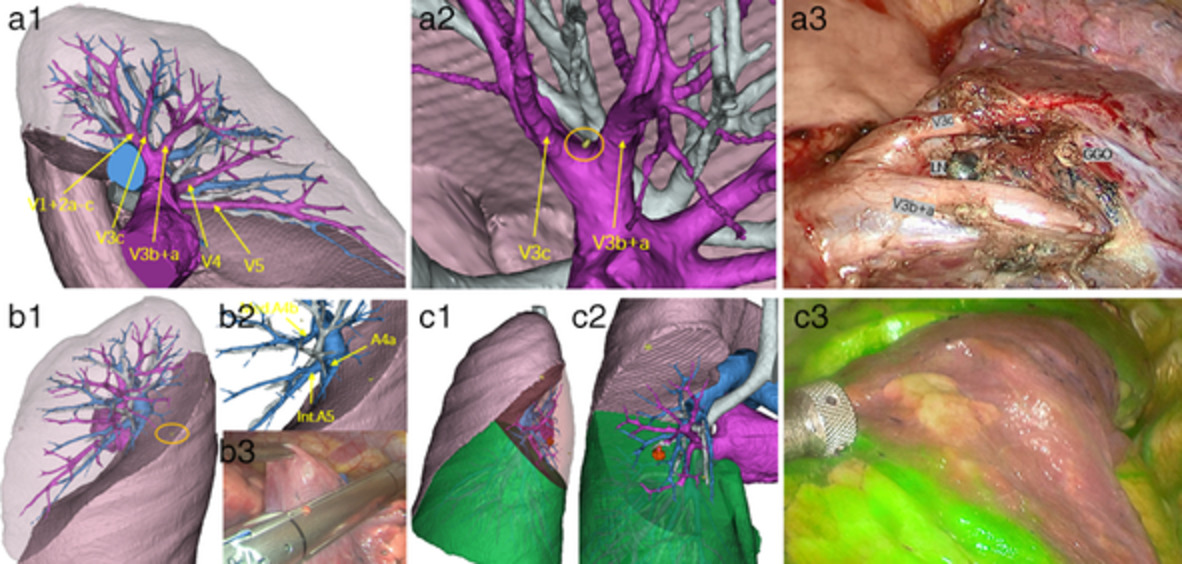 Precise resection of multiple pulmonary nodules using a three-dimensional reconstruction model: A case report