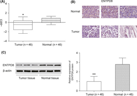 Identification of ENTPD8 and cytidine in pancreatic cancer by metabolomic and transcriptomic conjoint analysis