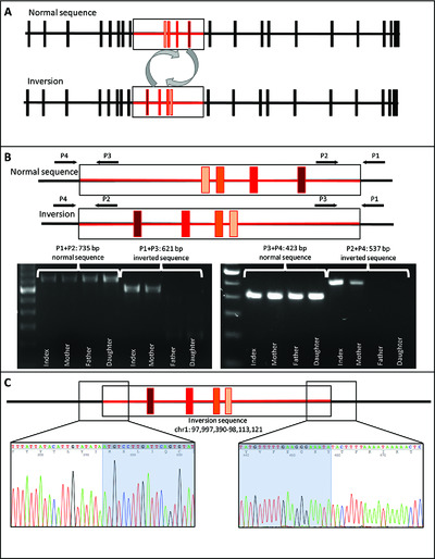 Genome sequencing reveals a novel genetic mechanism underlying dihydropyrimidine dehydrogenase deficiency: A novel missense variant c.1700G>A and a large intragenic inversion in DPYD spanning intron 8 to intron 12