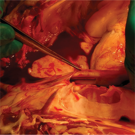 Dual-wavelength reflectance spectroscopy of the superior vena cava: A method for placing central venous catheters at the cavoatrial junction
