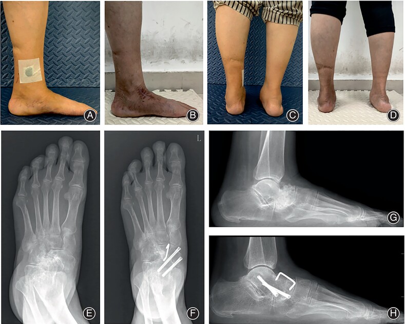 A Modified Fixation Method for Talonavicular Arthrodesis in the Treatment of Müller-Weiss Disease: The Use of the Shape-Memory Alloy Staple as an Adjunct