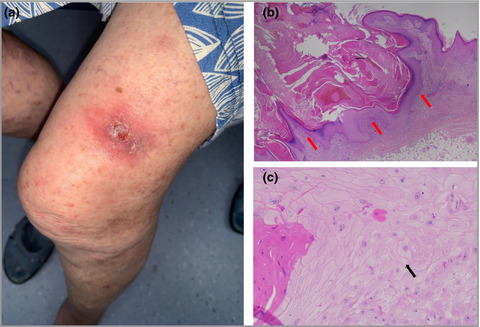 Eruptive keratoacanthomas associated with dupilumab therapy