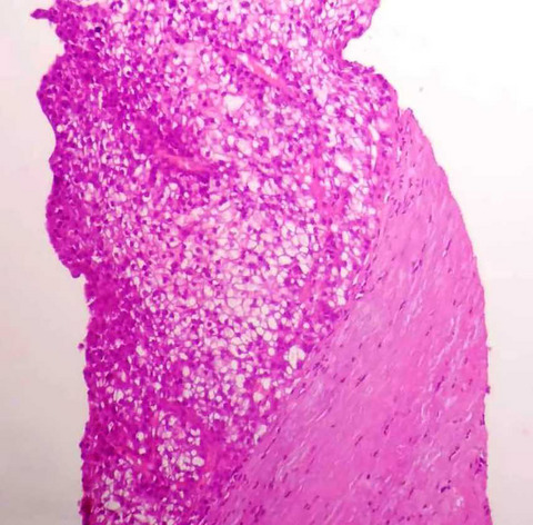 Hepatocellular carcinoma arising from hepatic adenoma in a young woman