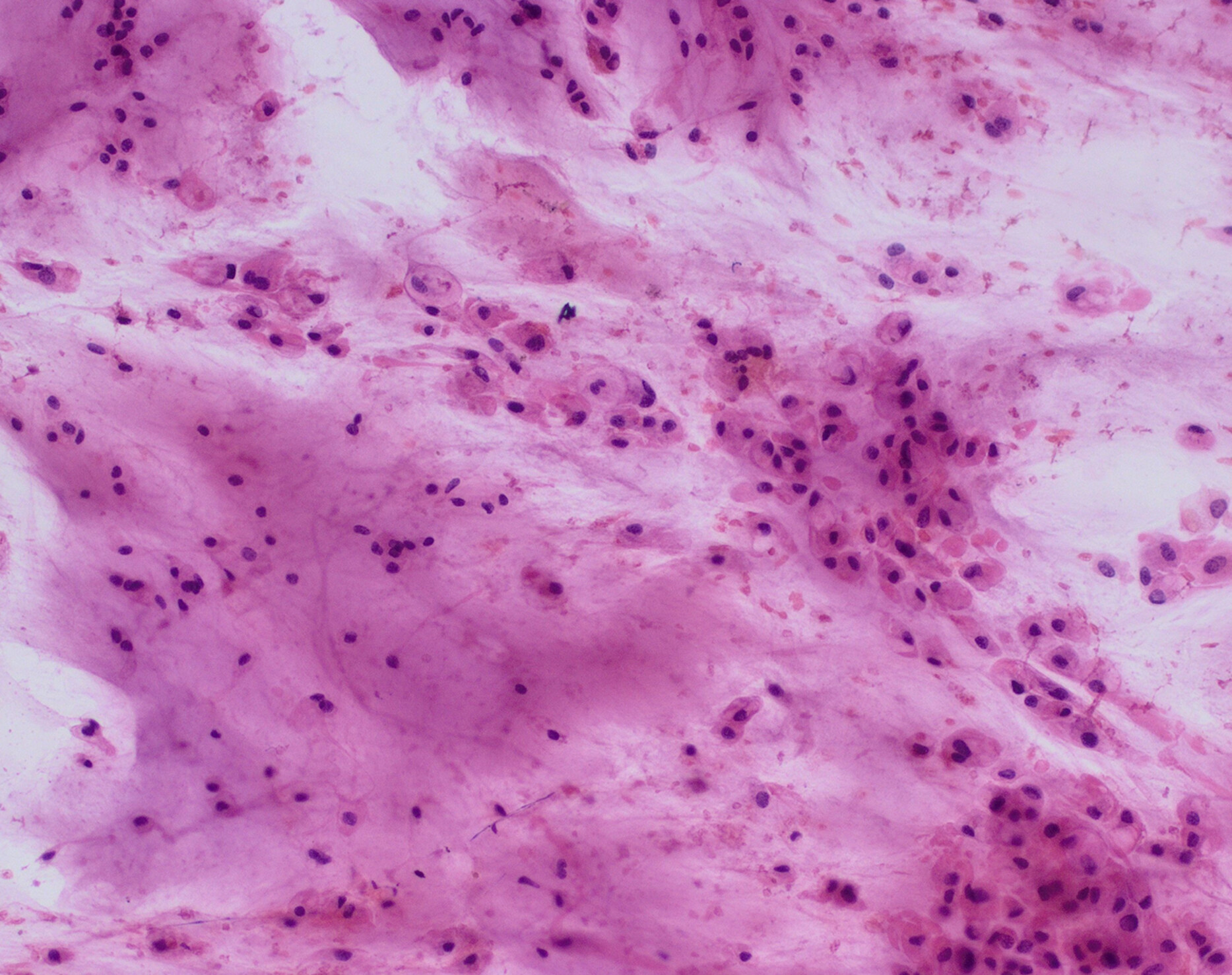 Squash smear and fine needle aspiration features of conventional chordoma
