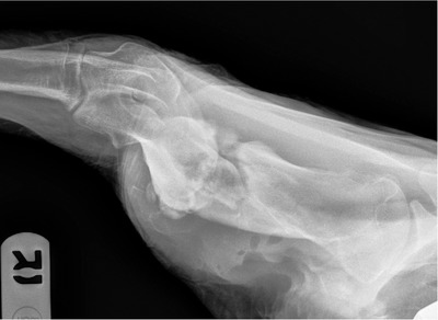 A case of canine Salmonella spp. osteomyelitis with secondary fracture following dog bite