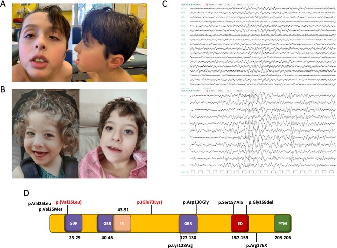Novel De Novo RALA Missense Variants Expand the Genotype Spectrum of Hiatt-Neu-Cooper Neurodevelopmental Syndrome