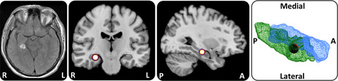 Transient topographical disorientation due to right-sided hippocampal hemorrhage