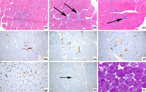 Pervasive inflammatory activation in patients with deficiency in very-long-chain acyl-coA dehydrogenase (VLCADD)