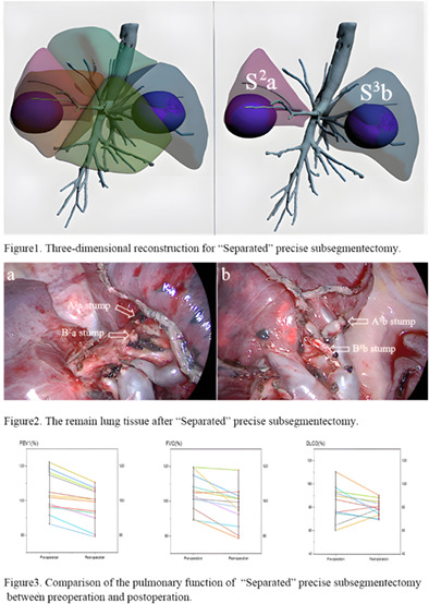 “Separated” precise subsegmentectomy: Single-port thoracoscopic noncombined subsegmentectomy in one lung lobe