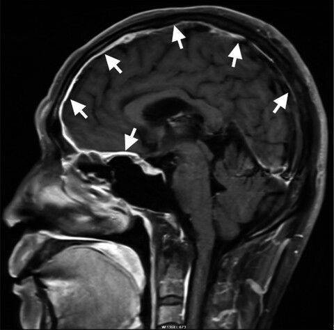 Rapid bilateral visual loss as the initial clinical manifestation in idiopathic hypertrophic cranial pachymeningitis
