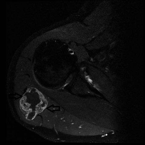 Intramuscular myxoma of the deltoid muscle in a swimmer: A rare case report and literature review