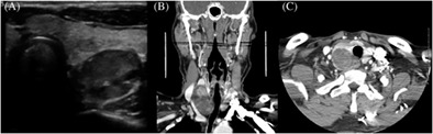 A multi-institutional study evaluating and describing atypical parathyroid tumors discovered after parathyroidectomy