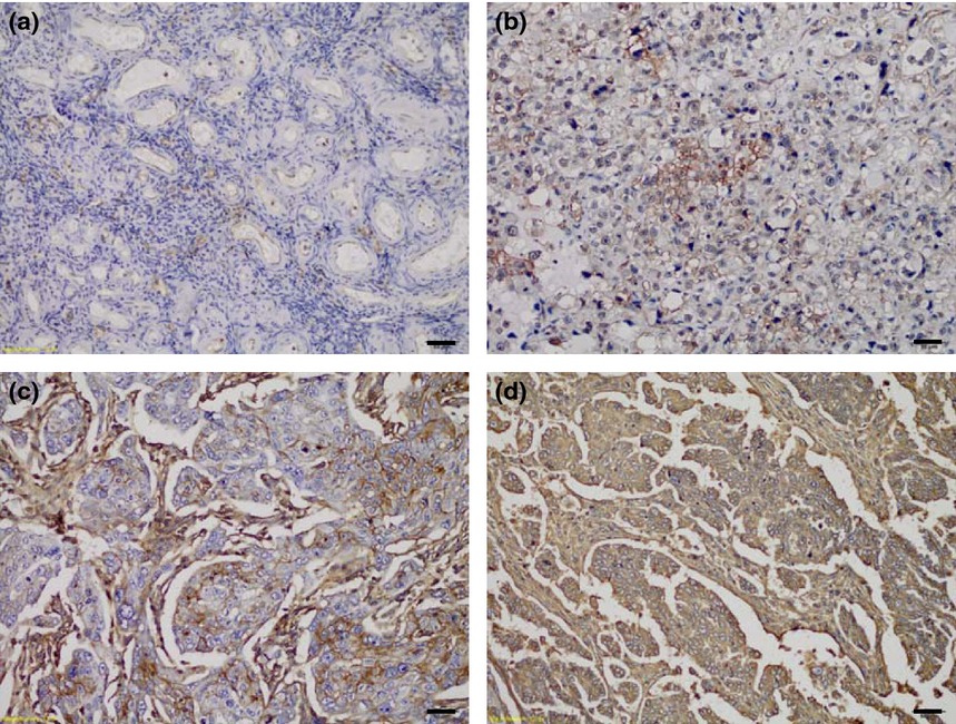 Human leukocyte antigen-E alleles and expression in patients with serous ovarian cancer