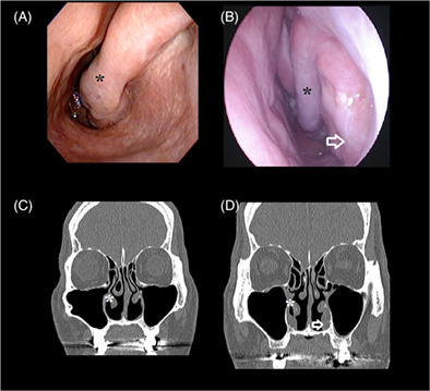 Suicidal thoughts in patients with empty nose syndrome