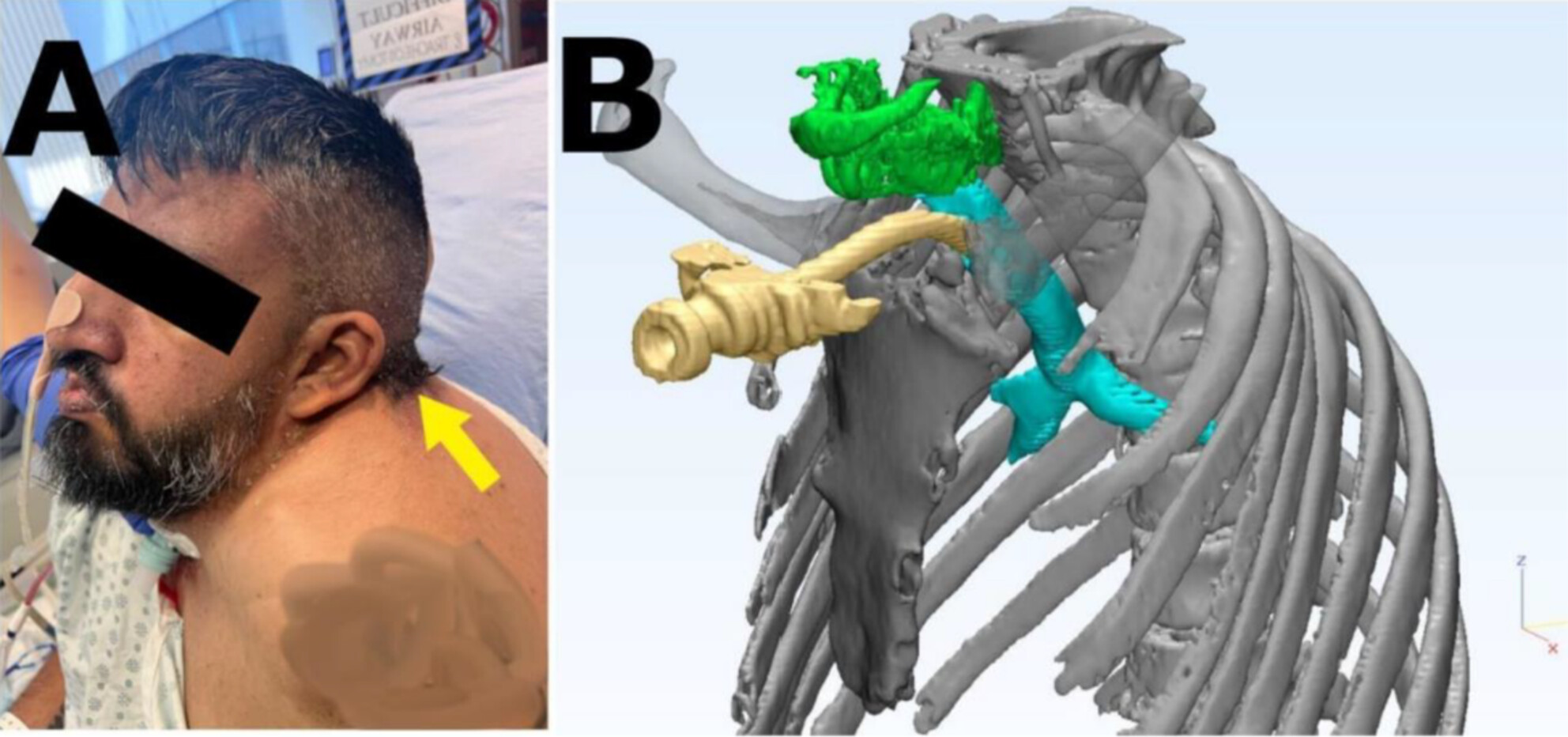 A Modified Tracheostomy Technique in an Adult Patient With Klippel–Feil Syndrome