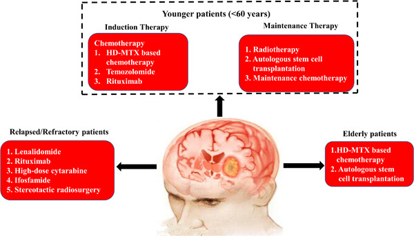 Advances and challenges in the treatment of primary central nervous system lymphoma