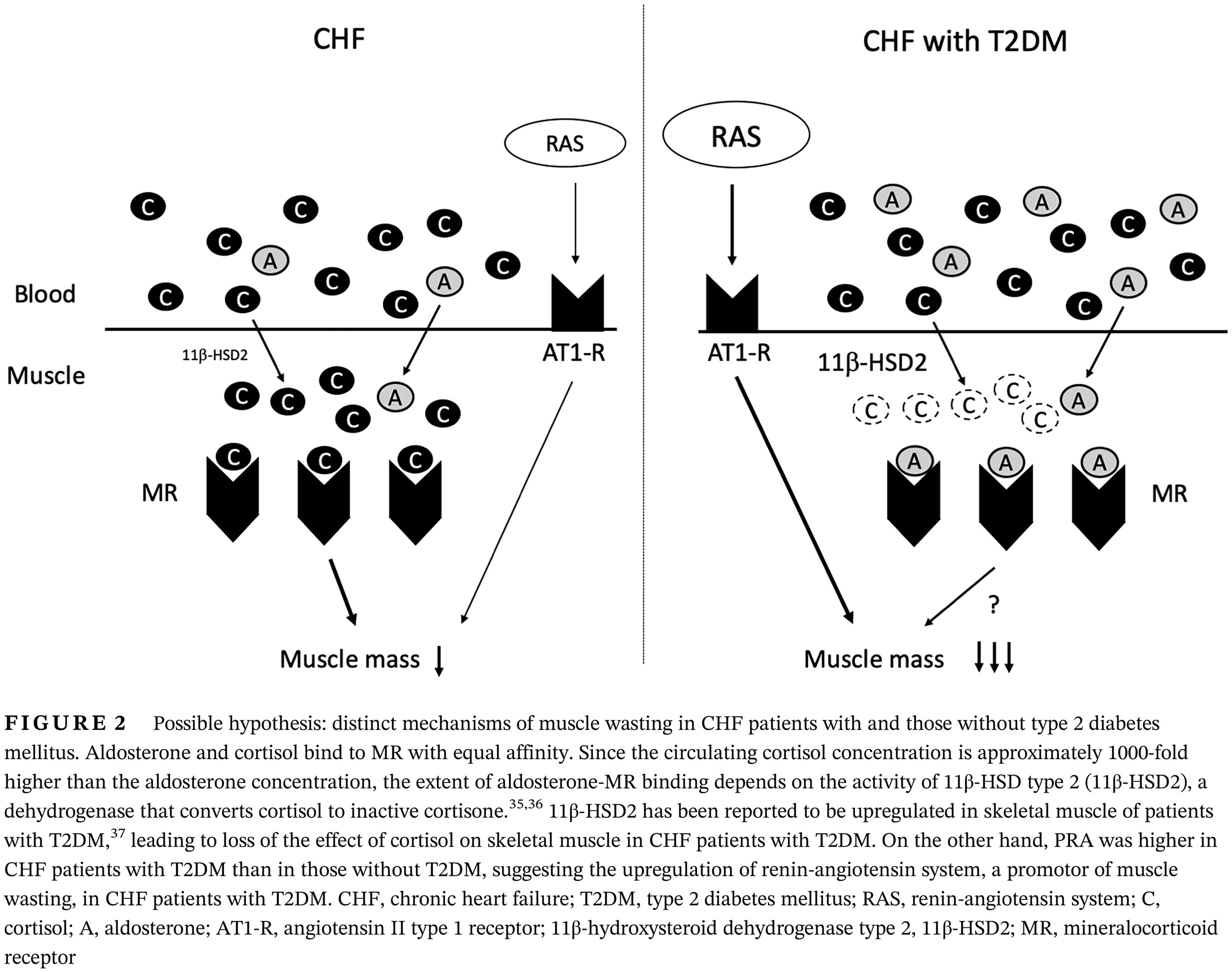 Distinct determinants of muscle wasting in nonobese heart failure patients with and without type 2 diabetes mellitus 伴有和不伴有2型糖尿病的非肥胖性心力衰竭患者肌肉萎缩的不同决定因素