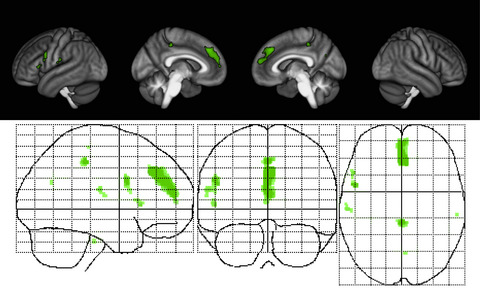 Estriol-mediated neuroprotection in multiple sclerosis localized by voxel-based morphometry