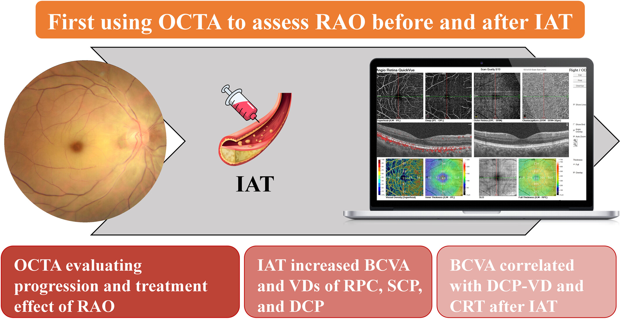 Optical coherence tomography angiography features of retinal artery occlusion before and after intra-arterial thrombolysis