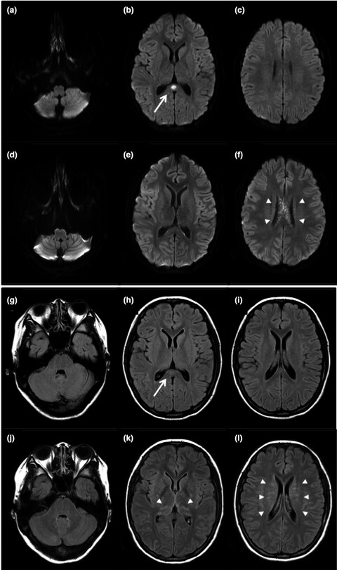 Case of autoimmune glial fibrillary acidic protein astrocytopathy associated with Epstein–Barr virus reactivation