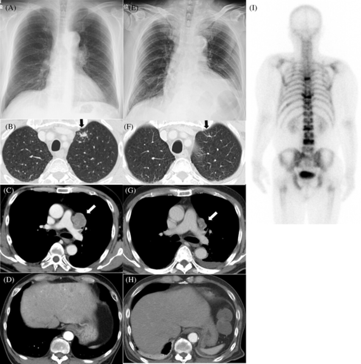 A case of disseminated intravascular coagulation following tumour lysis syndrome due to small cell carcinoma of the lung