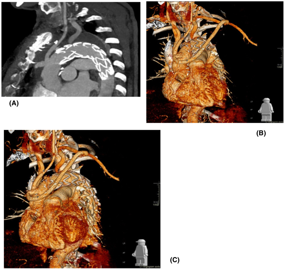 Aortic arch surgery for type B aortic dissection: How far should we go? The value of a hybrid approach