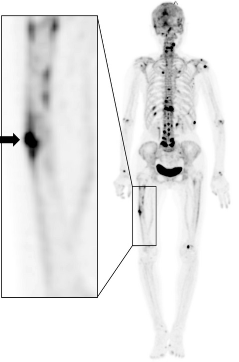 18F-sodium fluoride positron emission tomography may help determine better treatment for thigh pain after hip arthroplasty—A case report