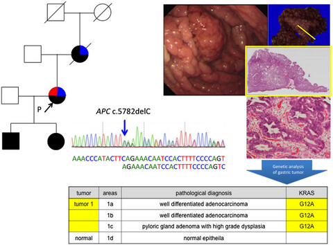 Genetic alteration of colorectal adenoma-carcinoma sequence among gastric adenocarcinoma and dysplastic lesions in a patient with attenuated familial adenomatous polyposis