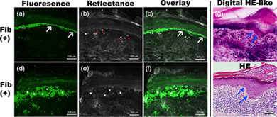 Immunofluorescence and histopathological assessment using ex vivo confocal laser scanning microscopy in lichen planus