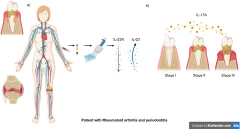 IL-23/IL-17 axis and soluble receptors isoforms sIL-23R and sIL-17RA in patients with rheumatoid arthritis-presenting periodontitis