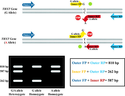 Association between TBXT rs2305089 polymorphism and chordoma in Iranian patients identified by a developed T-ARMS-PCR assay