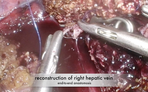 Laparoscopic two stage hepatectomy: combined Glissonean approach of hepatic pedicles and dorsal approach of right and middle hepatic veins and vascular reconstruction