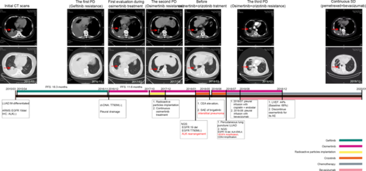 ALK rearrangements as mechanisms of acquired resistance to osimertinib in EGFR mutant non-small cell lung cancer