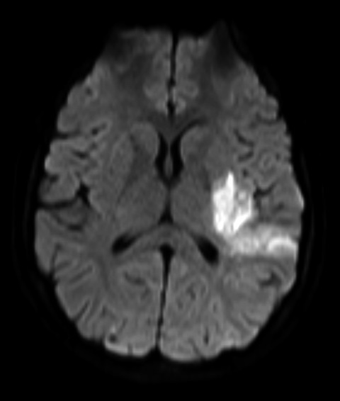 A review of the role of anticoagulation for patients with infective endocarditis and embolic stroke