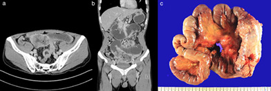 Metastatic large cell carcinoma of the lung: A rare cause of acute small bowel obstruction