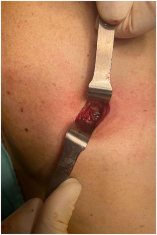 Diagnosis of malignant pleural disease: Ultrasound as “a detective probe”