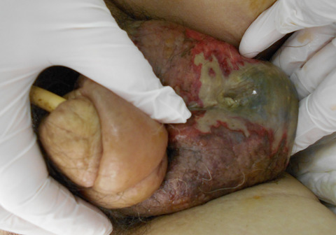 Severe acute pancreatitis with inflammation extending to the scrotum