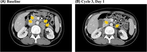 First-in-human phase I study of E7090, a novel selective fibroblast growth factor receptor inhibitor, in patients with advanced solid tumors