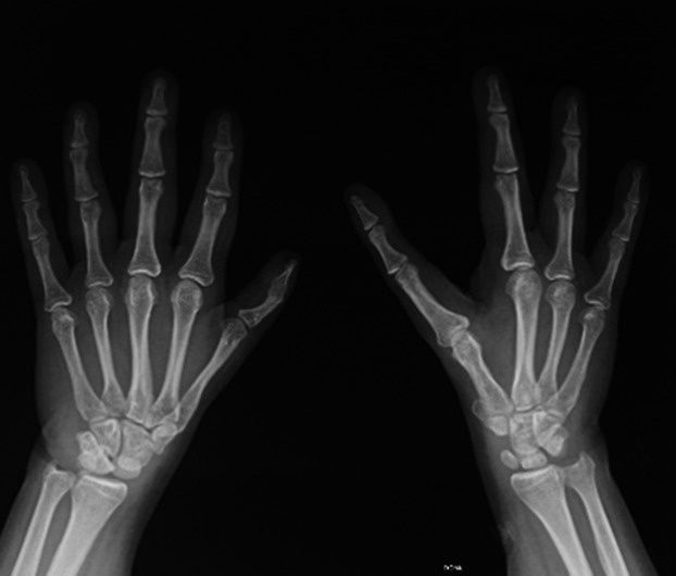 Adult-onset Diamond-Blackfan anemia with a novel mutation in the exon 5 of RPL11: too late and too rare