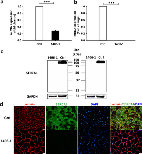 Identification of a pathogenic mutation in ATP2A1 via in silico analysis of exome data for cryptic aberrant splice sites