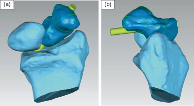 Determining the optimal radiologic wrist and forearm position to visualize screw protrusion in scaphoid fixation