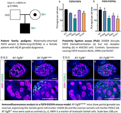 FGF9 variant in 46,XY DSD patient suggests a role for dimerization in sex determination