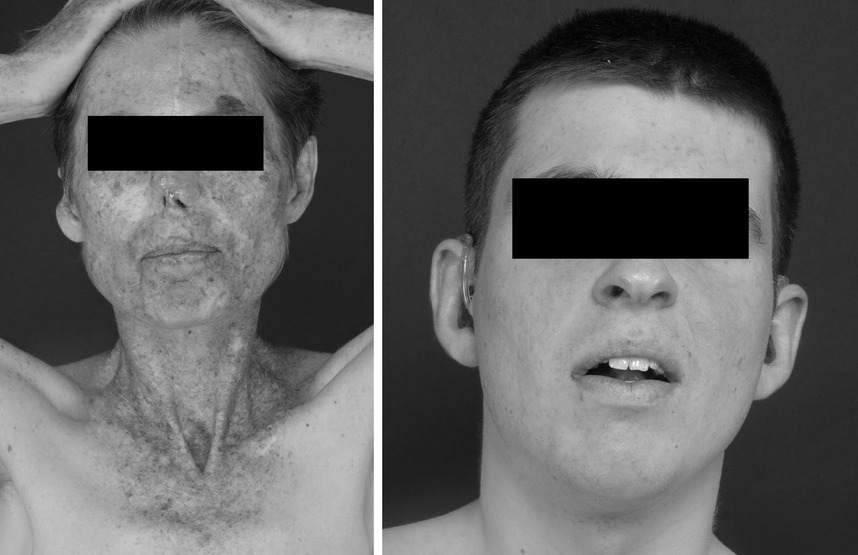 Xeroderma Pigmentosum in the United Kingdom