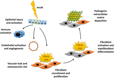 Idiopathic and immune-related pulmonary fibrosis: diagnostic and therapeutic challenges Issue 11, 2019